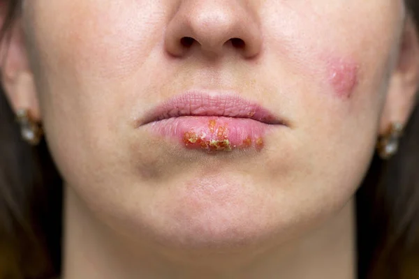 Closeup of a common cold sore virus herpes. Part of a young woman\'s face with a virus herpes on lips