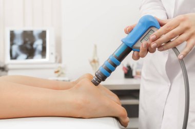 Extracorporeal Shockwave Therapy ESWT cerrahi olmayan tedaviler. Şok dalgalarıyla plantarfascitis için fizyoterapi. Ağrı kesici, normalleştirme ve yenilenme, iyileşme sürecinin canlandırılması.
