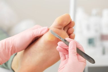 Bıçak tutacağı olan özel bir alet kullanılarak tıbbi pedikür prosedürü. Dieffenbach bisturi kullanan profesyonel pedikür. Hasta podiyatristi ziyaret ediyor.