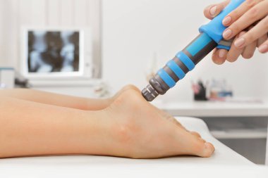 Extracorporeal Shockwave Therapy ESWT cerrahi olmayan tedaviler. Şok dalgalarıyla plantarfascitis için fizyoterapi. Ağrı kesici, normalleştirme ve yenilenme, iyileşme sürecinin canlandırılması.