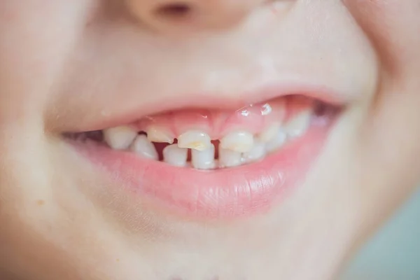 Детские зубы с кариесом — стоковое фото
