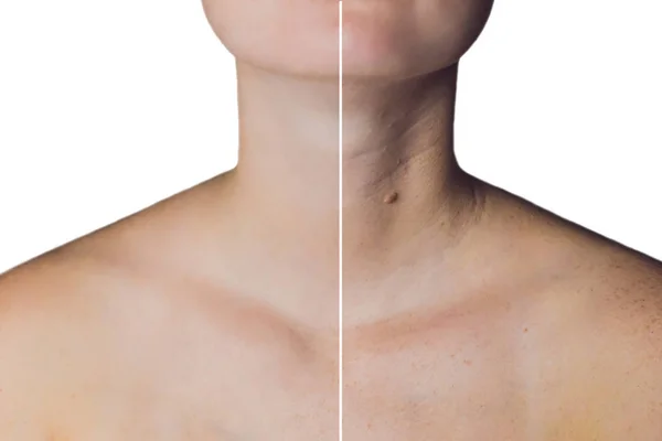 Neck of a woman before and after botox. — Stock Photo, Image