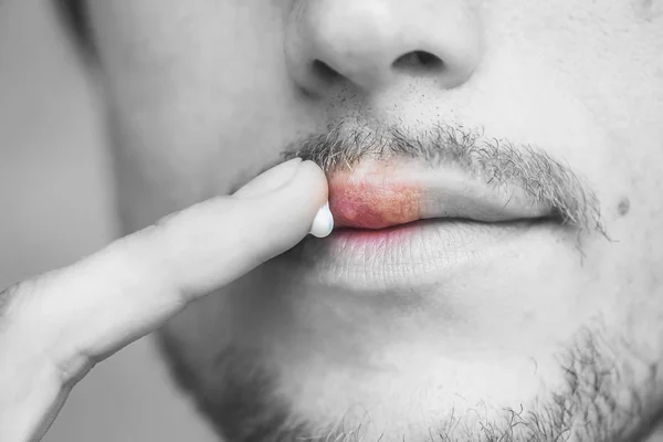 L'uomo spalma l'herpes con la crema di herpes — Foto Stock