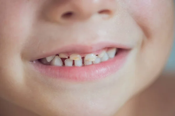 Dientes de leche con caries — Foto de Stock