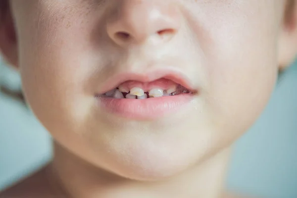 Mléčné zuby se kaz — Stock fotografie