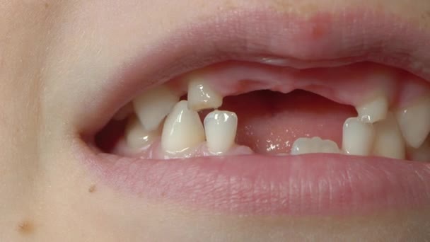 Macro shot di un ragazzino che mostra la bocca con i denti da latte mancanti. Concetto di cambiamento dei denti nei bambini — Video Stock