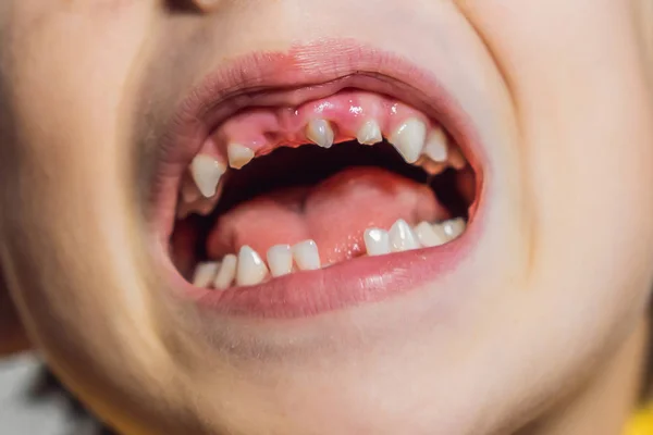 Abnormal boy tooth. The extra narrow strange tooth grew in the boys mouth. Boy shows his crooked tooth. Patient Orthodontist. Childrens teeth problems — Stock Photo, Image