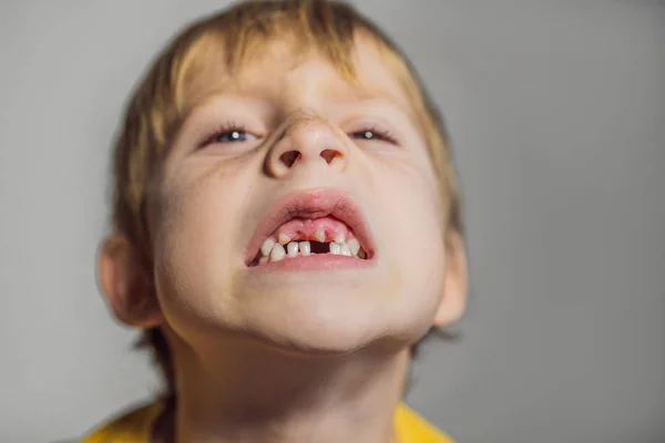 Un dente da ragazzo anormale. Lo strano dente extra stretto cresceva nella bocca dei ragazzi. Il ragazzo mostra il dente storto. Ortodontista paziente. Problemi ai denti dei bambini — Foto Stock