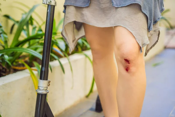 Mujer joven con una herida en la rodilla se cayó de un scooter — Foto de Stock