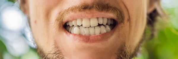 Man placerar en bitplatta i munnen för att skydda tänderna på natten från slipning orsakad av bruxism Banner, Long Format — Stockfoto