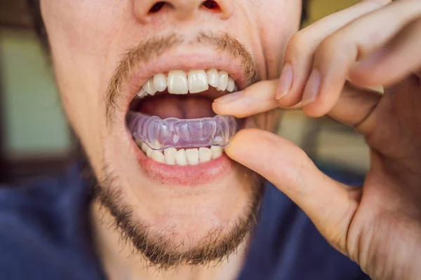 Mężczyzna wkłada płytkę do ust, by chronić zęby przed zgrzytaniem spowodowanym bruksizmem, z bliska obserwuje dłoń i urządzenie — Zdjęcie stockowe