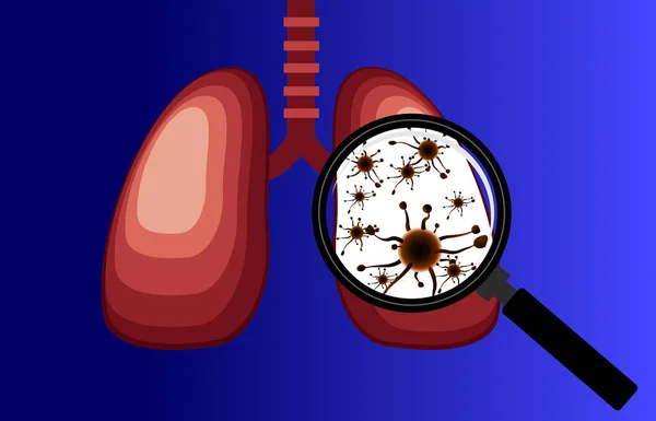 Вирус Бактерии Заразили Легкие Человека Болезнь Легких Увеличитель Обнаруживает Вирус — стоковый вектор