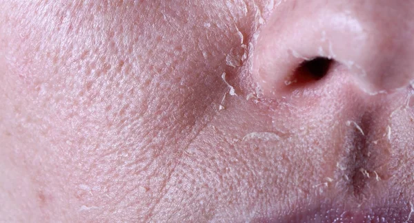 peeling of the girl on her face skin peeled off