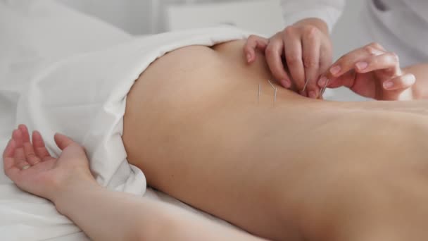 Läkaren sticker in nålar i flickor kroppen på akupunktur — Stockvideo