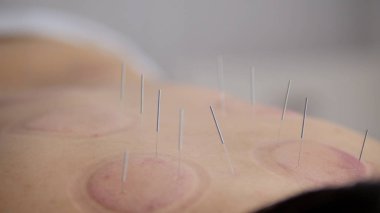 Arkasında bir kadın doğum akupunktur iğneleri
