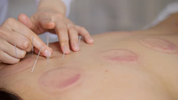 O médico coloca agulhas no corpo das mulheres na acupuntura — Fotografia de Stock
