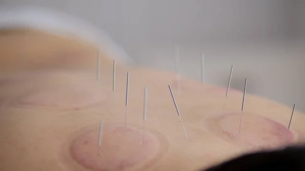 Agujas en la espalda de una mujer con acupuntura — Foto de Stock