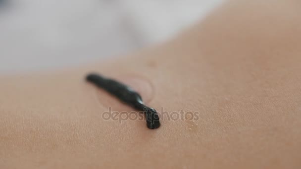 Hirudotherapy in clinic - Leech on skin of woman — Stock Video