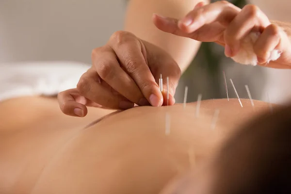 Läkaren sticker in nålar i flickor kroppen på akupunktur - närbild — Stockfoto