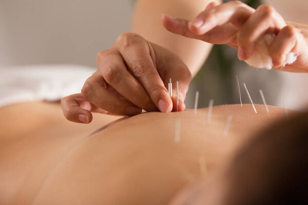 The doctor sticks needles into the girls body on the acupuncture - close up
