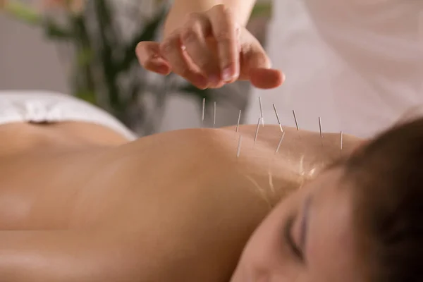 O médico coloca agulhas no corpo das meninas na acupuntura — Fotografia de Stock