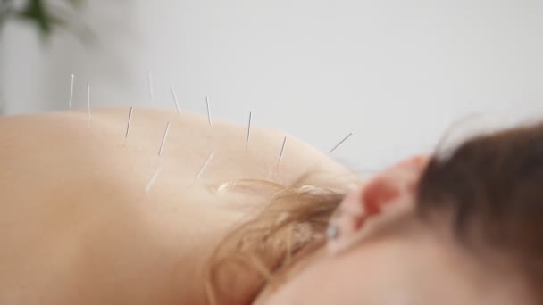 Alternativmedizin - Doktornadeln auf der Akupunktur in den Frauenkörper — Stockvideo