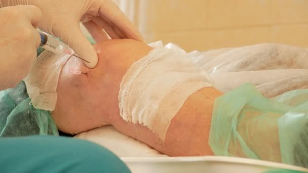 Knieoperation - der Arzt entleert die Flüssigkeit mit einer Spritze aus dem Knie des Patienten — Stockvideo