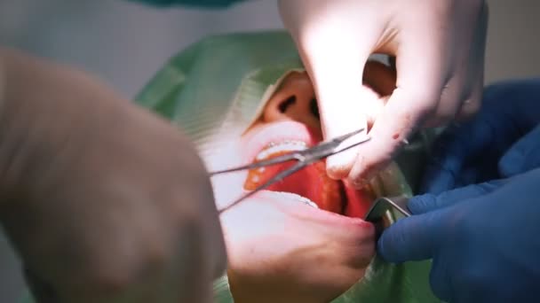 Medico dentista esegue una procedura di anestesia locale durante la chirurgia stomatologica — Video Stock