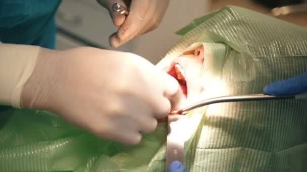 Лікар стоматолог проводить процедуру місцевої анестезії під час стоматологічної хірургії — стокове відео