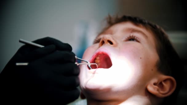 Un niño pequeño con dientes de bebé dañados que tiene un tratamiento en la odontología moderna — Vídeo de stock