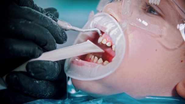 Un niño pequeño con dientes de bebé dañados que tiene un tratamiento en la odontología: limpiar los dientes con un chorro de agua — Vídeos de Stock