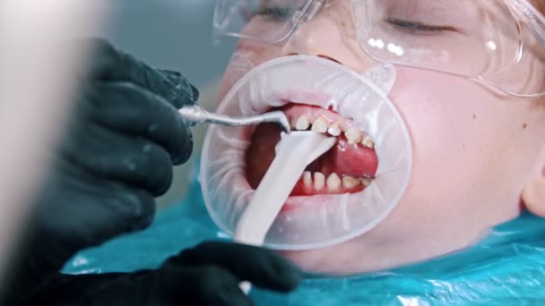 Un niño pequeño con gafas protectoras que tiene un tratamiento de limpieza de dientes en la odontología moderna recoger agua con un tubo de succión de la boca — Vídeo de stock