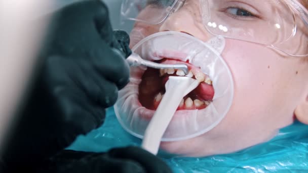 Um menino em óculos de proteção que tem um tratamento de limpeza dos dentes na odontologia recolher o excesso de água com um tubo de sucção da boca — Vídeo de Stock