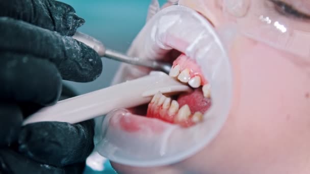 A little boy in protective glasses with baby teeth having a teeth cleaning treatment in the dentistry - collect the excess water with a suction tube from the mouth — Wideo stockowe