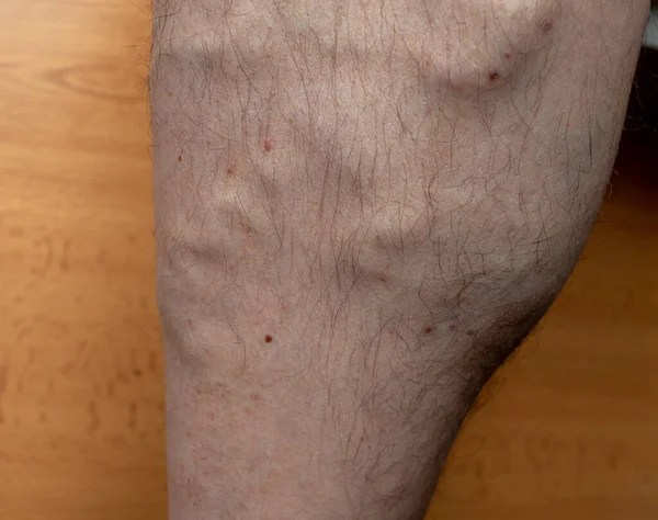 varicose veins on the right ankle. a neglected form of varicose. bloated veins and health hazards. the leg with bloating veins. veins are swollen. photos of varicose