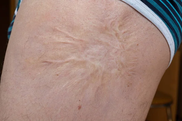 Cicatriz Após Cirurgia Anca Cicatriz Pele Grande Cicatriz Área Perna — Fotografia de Stock