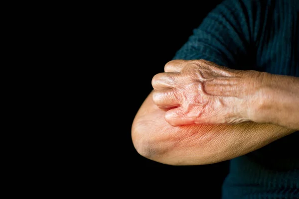 Mãos Velhas Coceira Braço Fundo Preto Conceito Dermatite — Fotografia de Stock