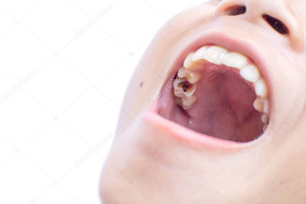 Close-up of mouth on white background,Tooth decay and oral health in children.