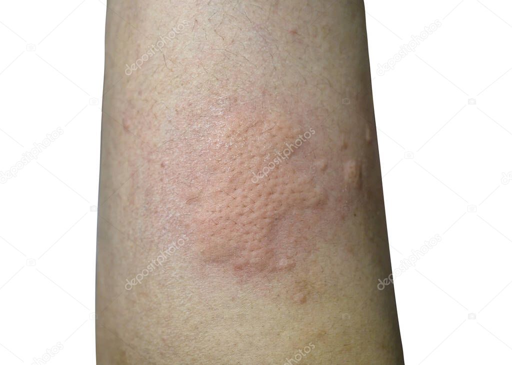 Swollen and inflamed skin from insect stings on thigh 