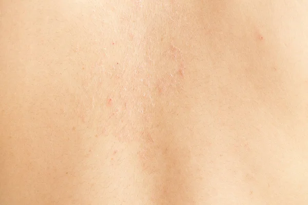 Skin Symptoms Itchy — Stock Photo, Image