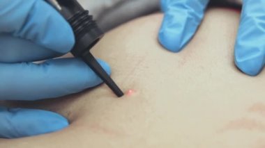 Lazer karbondioksit temizleme, yakın plan.