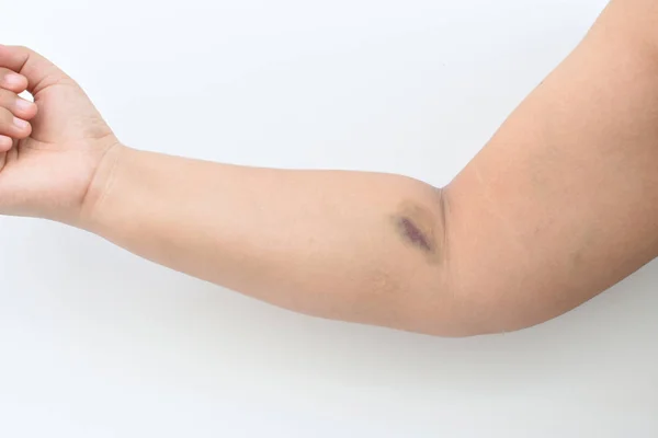 Feche Uma Contusão Pele Mulher Mãos Após Análise Sangue — Fotografia de Stock