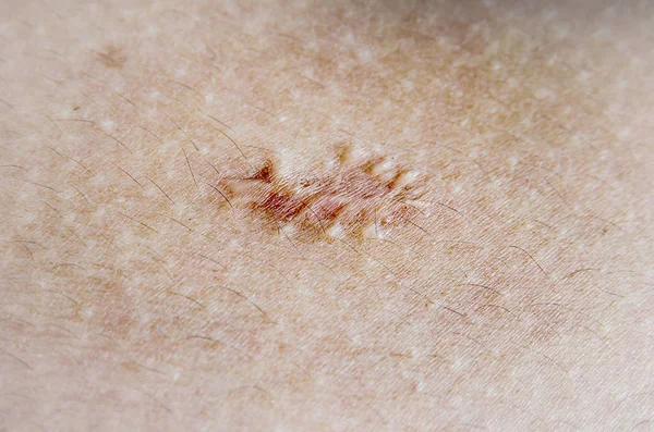 Keloid skar cilt üzerinde kapatın