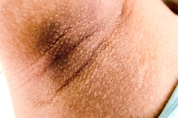 Close-up axila preta, efeito mulheres gravidez — Fotografia de Stock