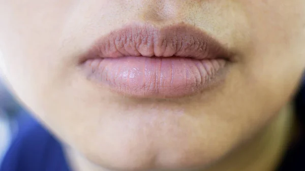 乾燥唇 コンセプト リップ軟膏傷とアジアの女性の口をクローズ アップ — ストック写真