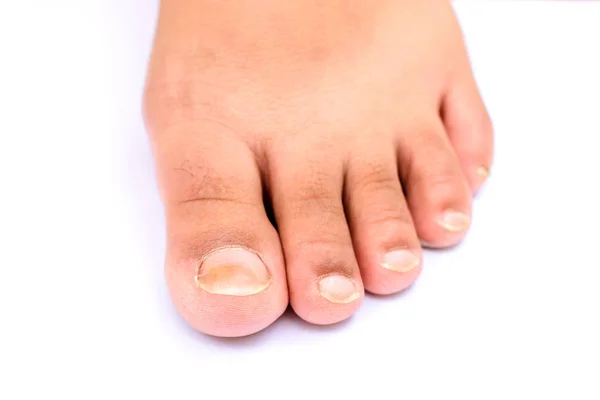 Fungus Infection Nails Asian Women Foot White Background — Stock Photo, Image