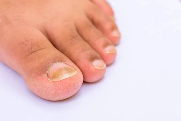 Fungus Infection on Nails of Asian women\'s Foot. white background.