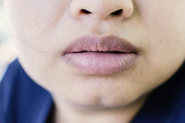 Closeup Boca Mulher Asiática Com Lábios Quebradiços Secos Conceito Lábio — Fotografia de Stock