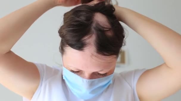 Real alopecia areata i en ung flicka. — Stockvideo