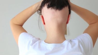 Genç bir kızda gerçek bir alopecia areata. Kel kafalı bir insan..